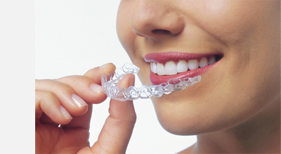 invisalign braces